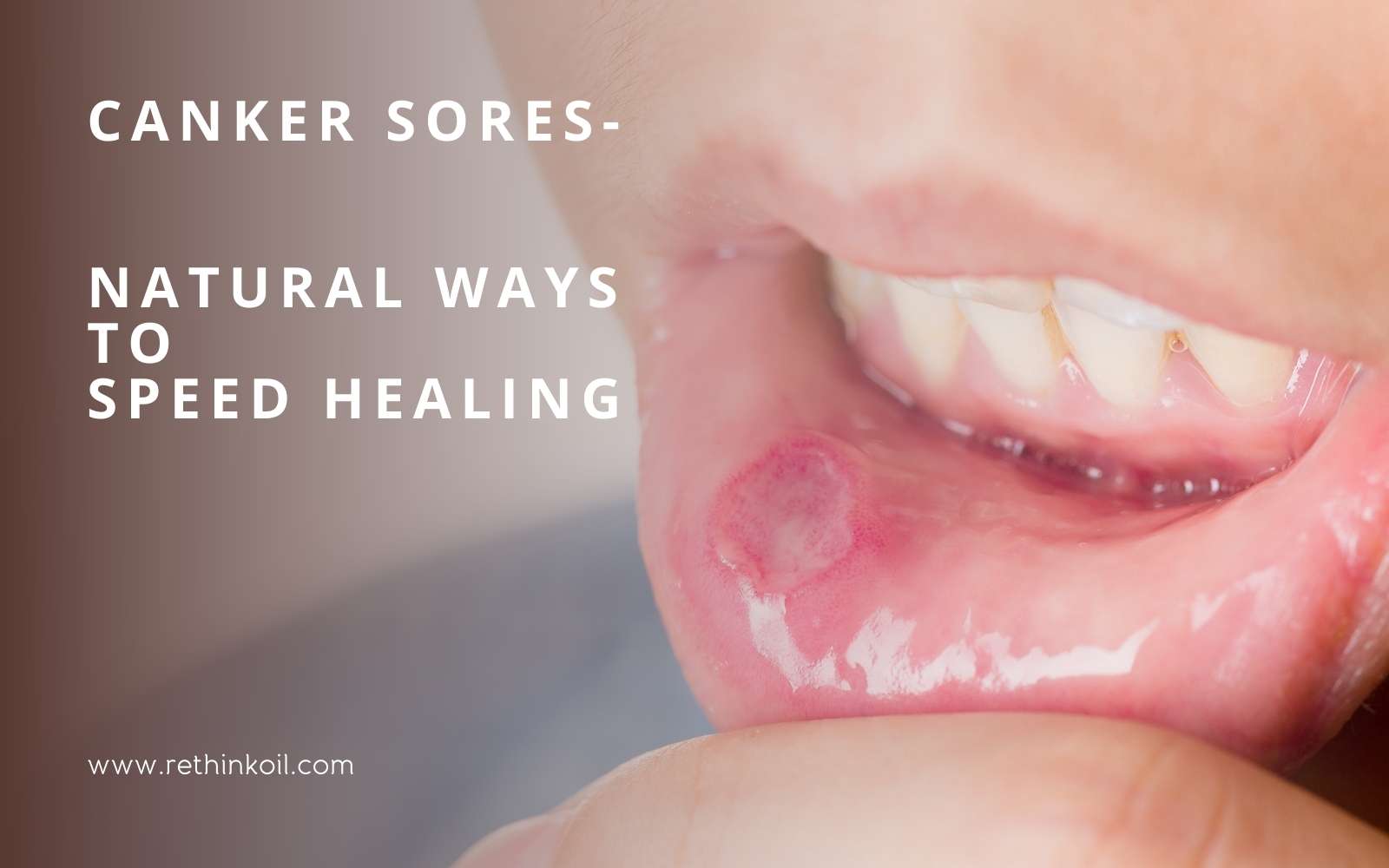 ReThinkOil Blog Canker Sores